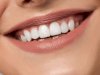 How Teeth Whitening Cost Matches Expectations