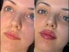 Fillers Treatment in Dubai for Smooth Wrinkle-Free Skin
