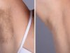 Best Aesthetic Clinic in dubai: Electrolysis Laser Hair Removal Aftercare