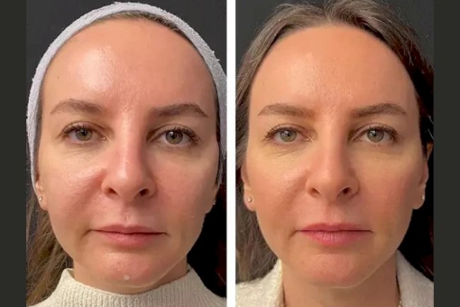 Mesotherapy Treatments in Dubai for Skin Rejuvenation