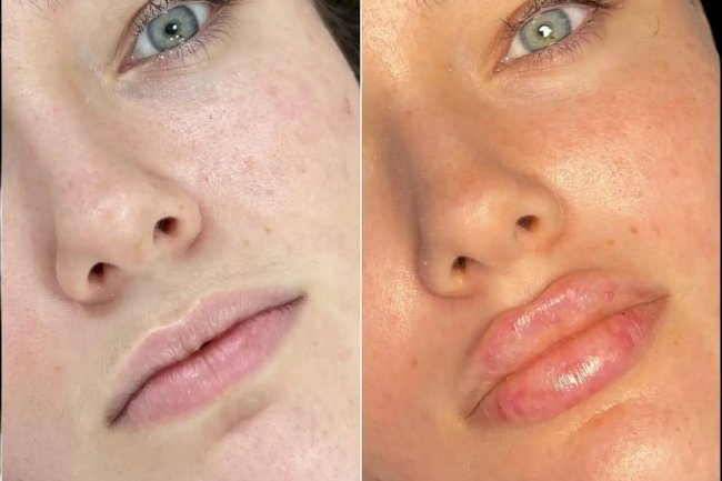 Fillers in Dubai: Restore Volume and Youthful Contours