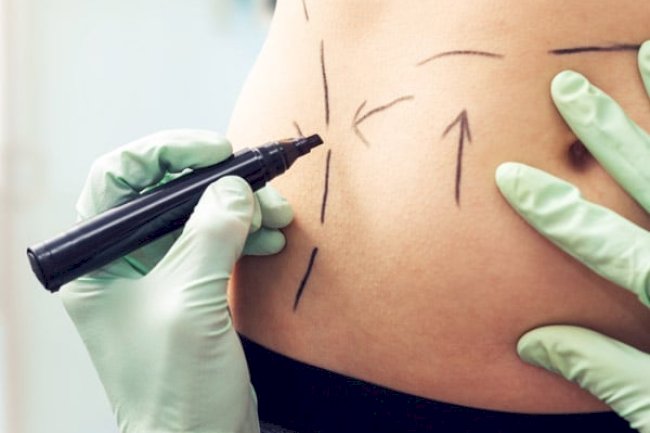 Factors That Affect Liposuction Cost in Dubai