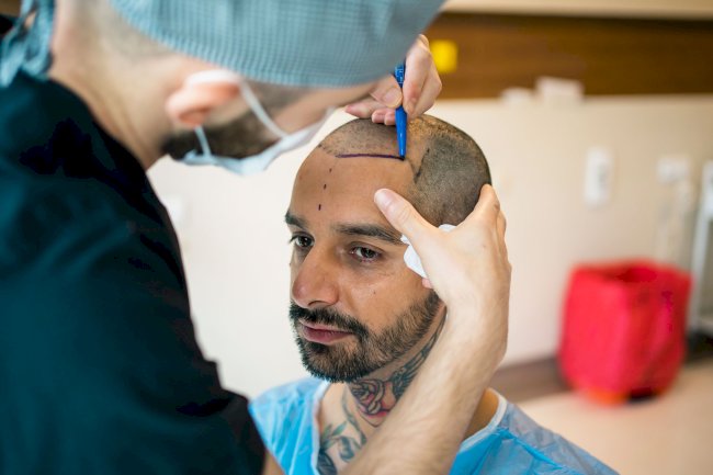 How Hair Transplants Have Evolved Over the Last Decade