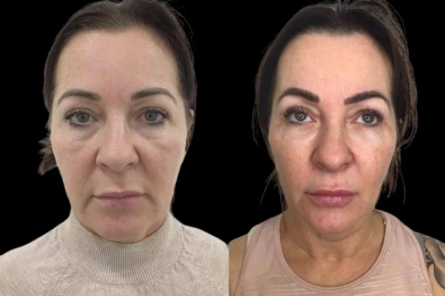 Best Doctors in Dubai for Profhilo: Addressing Common Concerns and Myths