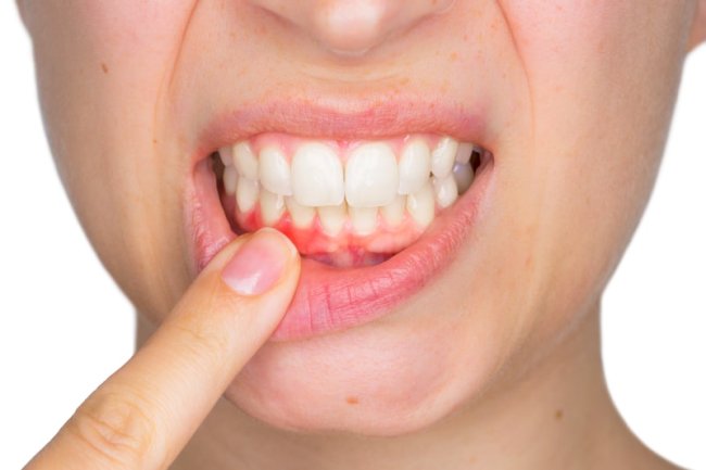 What Your Gums Say About Your Health - Dental Pros Explain