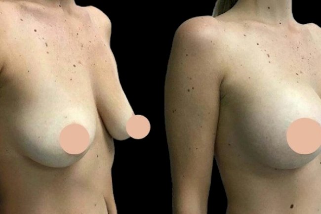 Combining Breast Enhancement Surgery in Dubai with Other Cosmetic Procedures