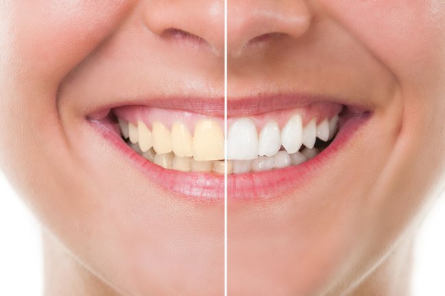 Why Teeth Whitening Cost Varies So Much in Different Places