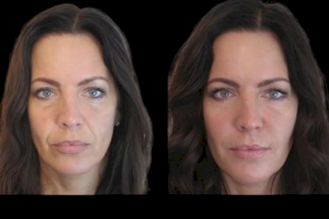 Achieve a Sculpted Jawline with the Best Plastic Surgeon in Dubai for Jawline Fillers