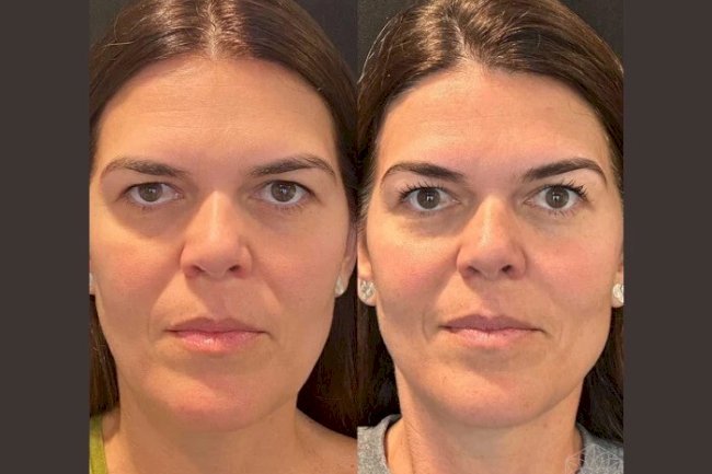 Rejuvenate Naturally with Thread Lift from the Best Doctors in Dubai