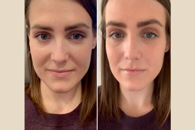 PRP Treatment in Dubai: A Complete Guide for Beginners
