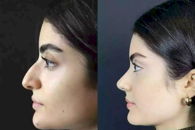 Can the Best Rhinoplasty Surgeon in Dubai Achieve Subtle Enhancements?