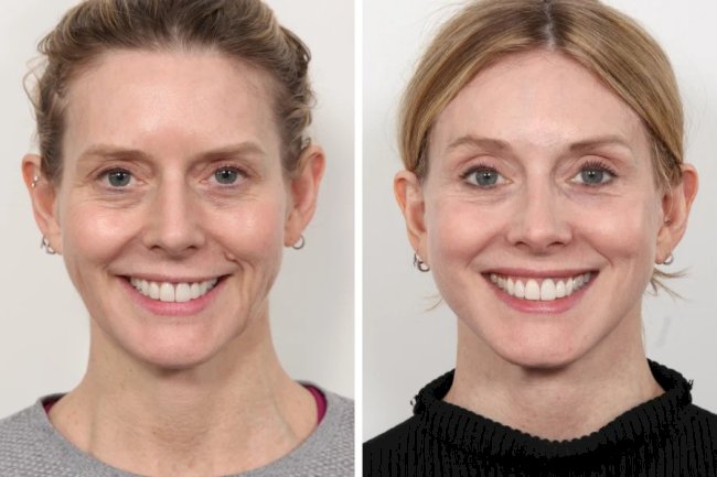 Best Plastic Surgeon in Dubai Shares Signs You’re Ready for a Thread Lift