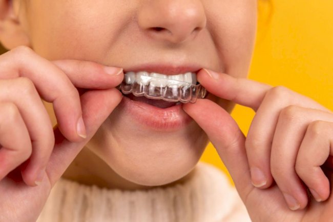 Do You Need Retainers After Invisalign Braces Treatment?