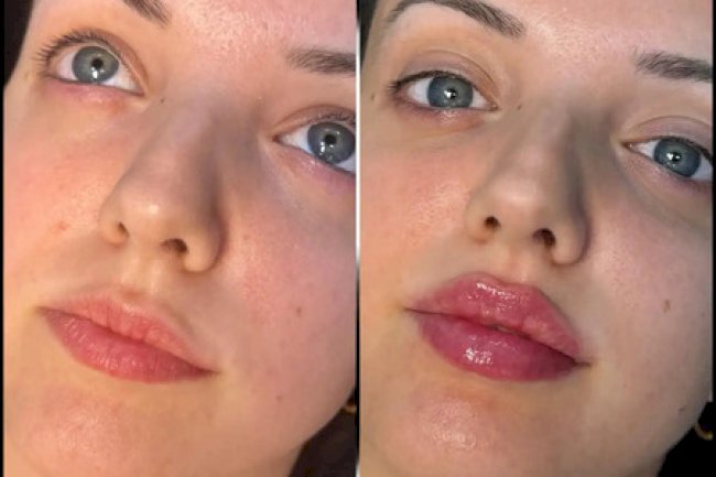 Before and After: Real Results of Fillers Treatment in dubai