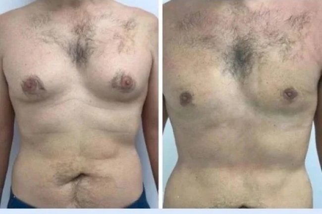 How to Determine if You’re a Candidate for Best Gynecomastia Surgeons in dubai Surgery