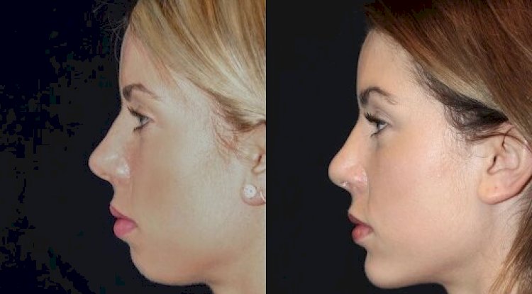 Chin Fillers Treatments in Dubai for Aging Skin: Benefits and Expectations