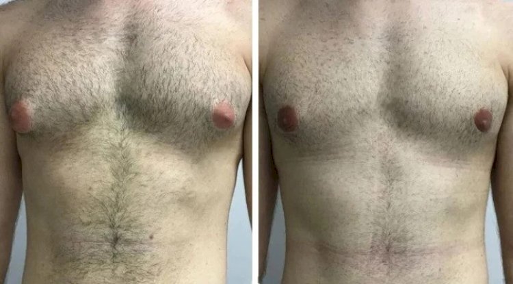 Latest Technology Used in Gynecomastia Surgery in Dubai