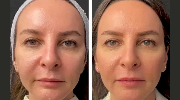 Mesotherapy Treatments in Dubai for Skin Rejuvenation