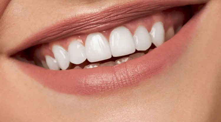 How Teeth Whitening Cost Matches Expectations