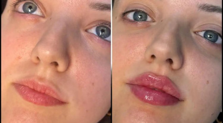Innovative Fillers Techniques at the Best Aesthetic Clinic in dubai