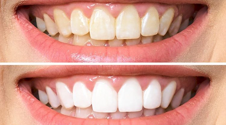 Teeth Whitening Cost or At-Home Kits: Which Lasts Longer?