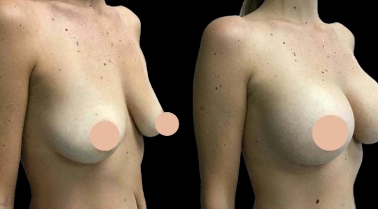 Combining Breast Enhancement Surgery in Dubai with Other Cosmetic Procedures