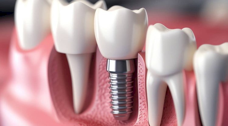 Are Dental Implants Right For You in New Port Richey?
