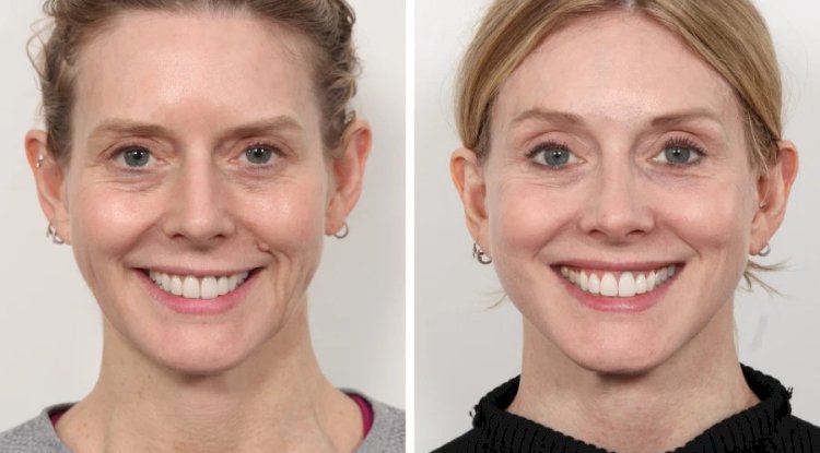 Innovations in Thread Lift Technology Used by the Best Doctors in Dubai