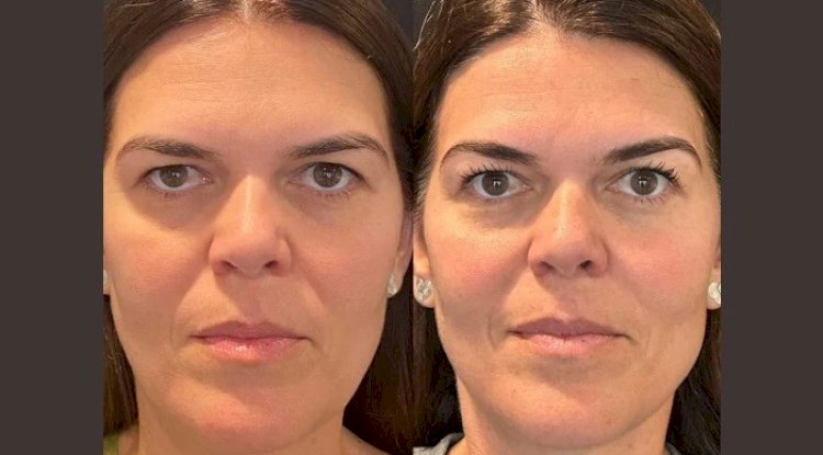 Rejuvenate Naturally with Thread Lift from the Best Doctors in Dubai