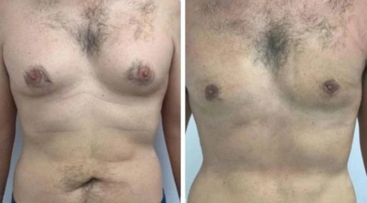Gynecomastia in Dubai with financing support