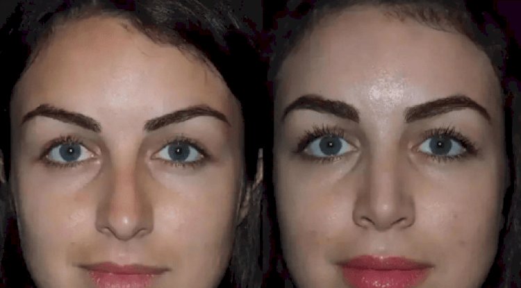 Rhinoplasty in Dubai: Enhancing Beauty and Breathing