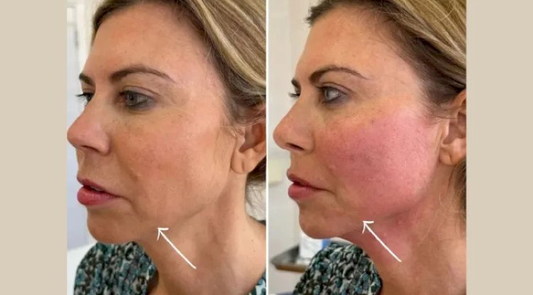 How to Prepare for Your First Endolift in Dubai – Expert Tips