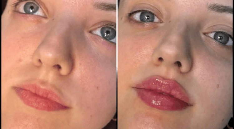 Best Plastic Surgeons in Dubai Known for Precision in Dermal Fillers
