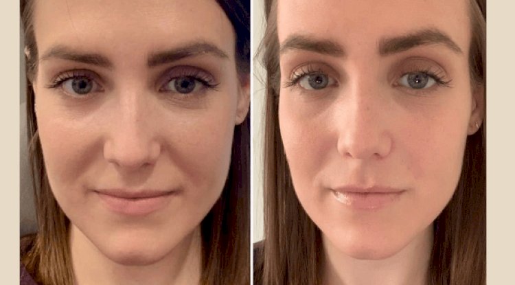 Best Plastic Surgeon in dubai for PRP Treatment for Men and Women