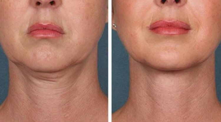 Best Plastic Surgeons in Dubai Recommended for PRP Treatment