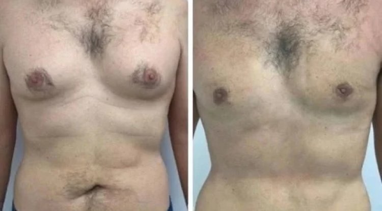 How to Determine if You’re a Candidate for Best Gynecomastia Surgeons in dubai Surgery