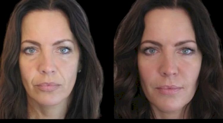 Best Plastic Surgeons in Dubai for Non-Surgical Jawline Perfection