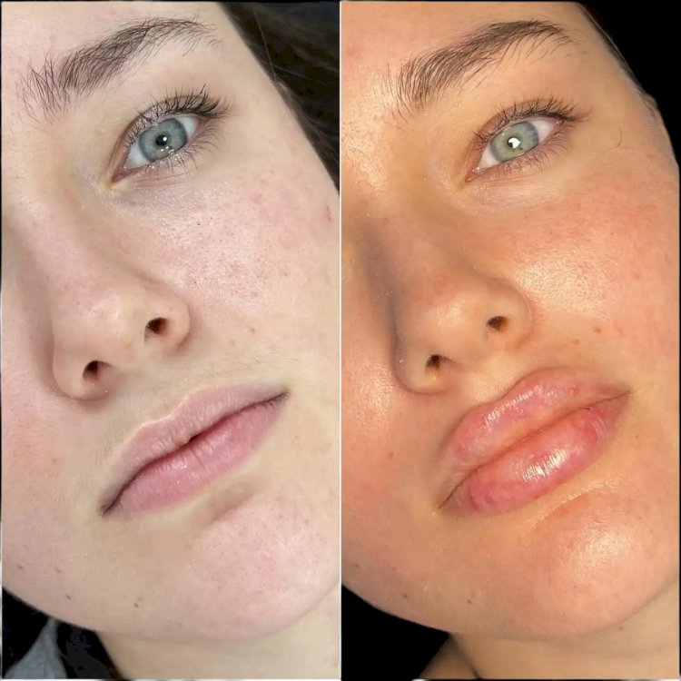 Fillers Treatments in Dubai for a Lifted and Contoured Face