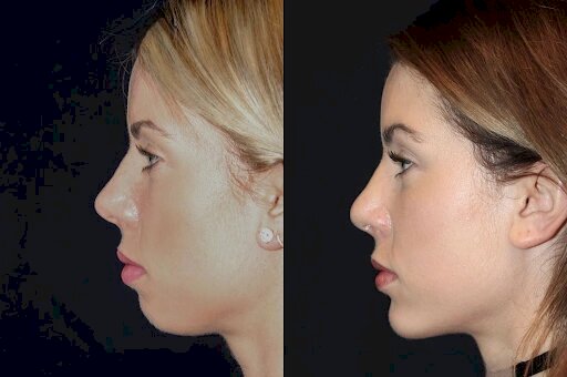 Chin Fillers Treatments in Dubai for Aging Skin: Benefits and Expectations