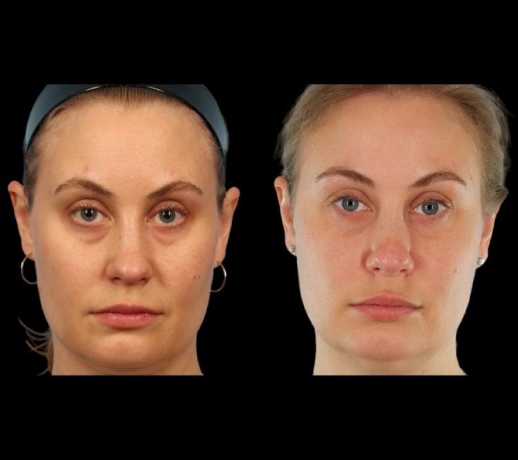 The Process of Under Eye Fillers at the Best Aesthetic Clinic in Dubai