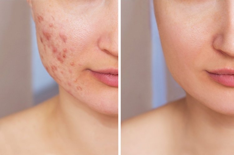 Clear Skin Journey: A Natural Approach to Managing Acne
