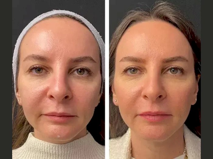 Mesotherapy Treatments in Dubai for Skin Rejuvenation