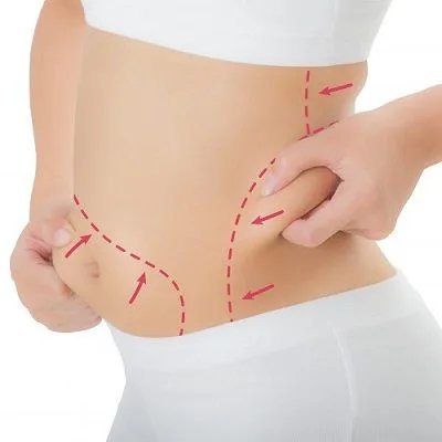How to Estimate Your Liposuction Cost in Dubai Accurately