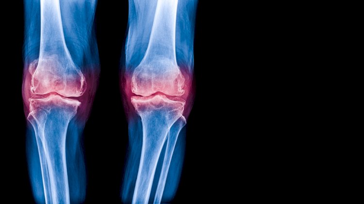 Is Sclerosis the Same as Osteoarthritis? Here’s What You Need to Know 