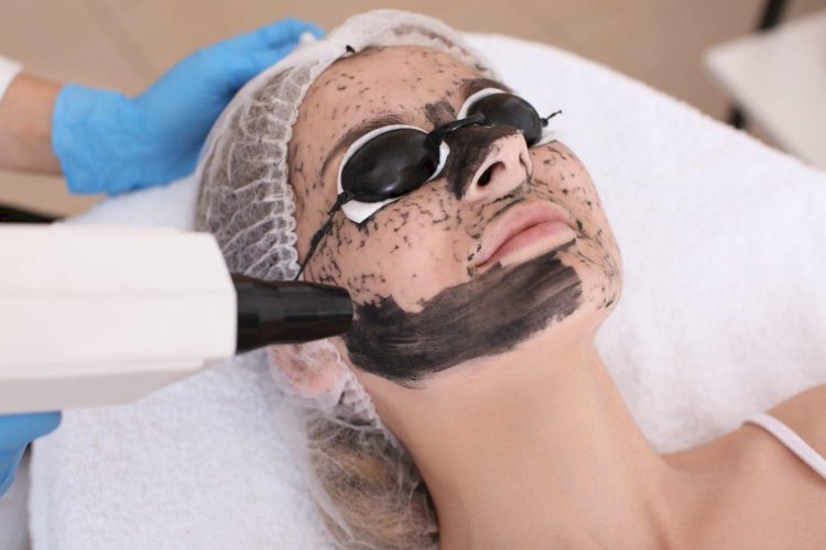 Can Laser Carbon Peel Help With Acne and Oily Skin?