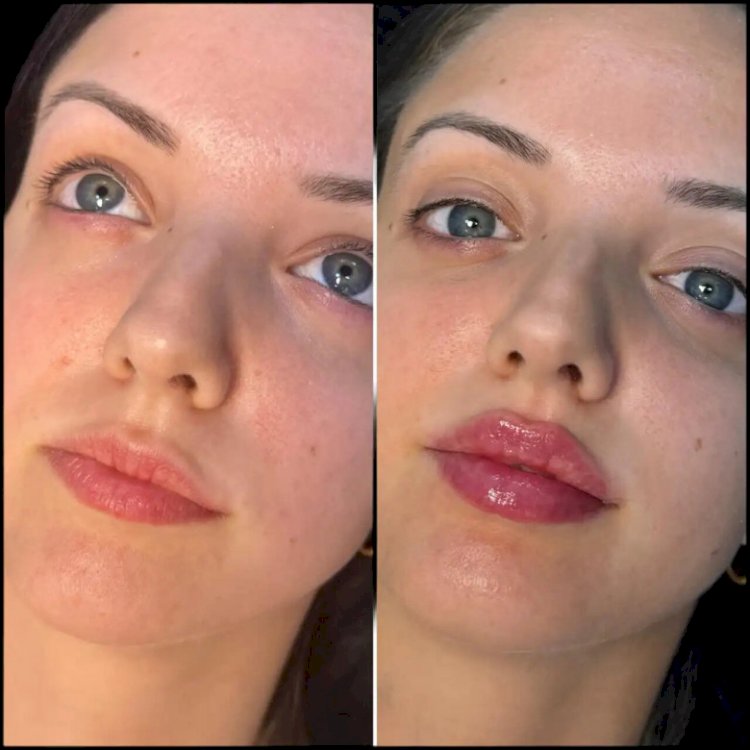 Best Doctors in dubai for Fillers Compare Techniques