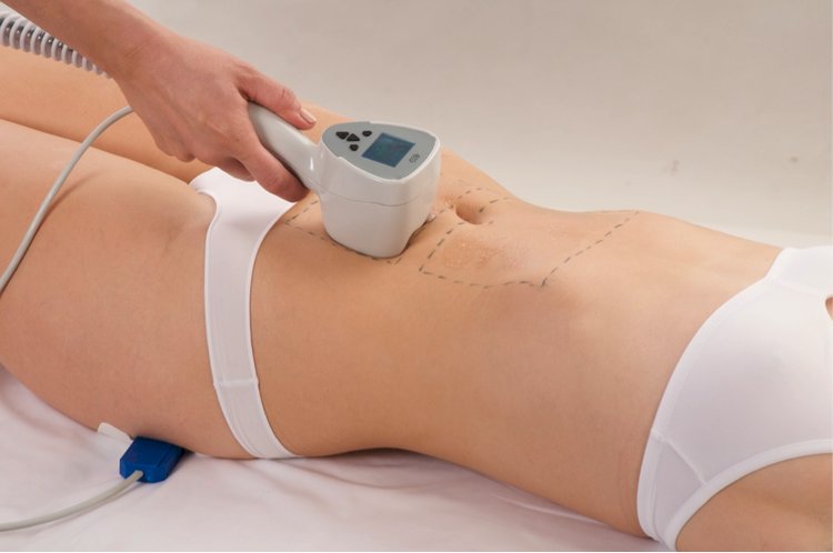 How Many Sessions Are Needed for Exilis Treatment?