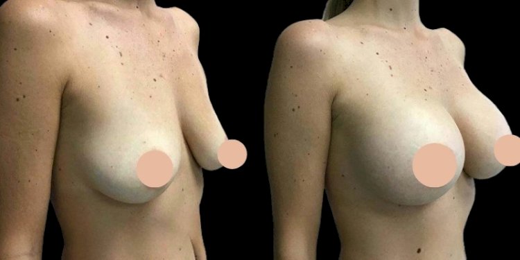 Best Doctors in Dubai Share What to Expect During Breast Augmentation Recovery