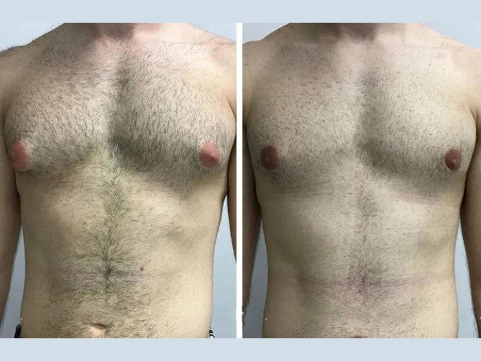 Look Sharp, Feel Strong with the Best Gynecomastia Surgeon in Dubai