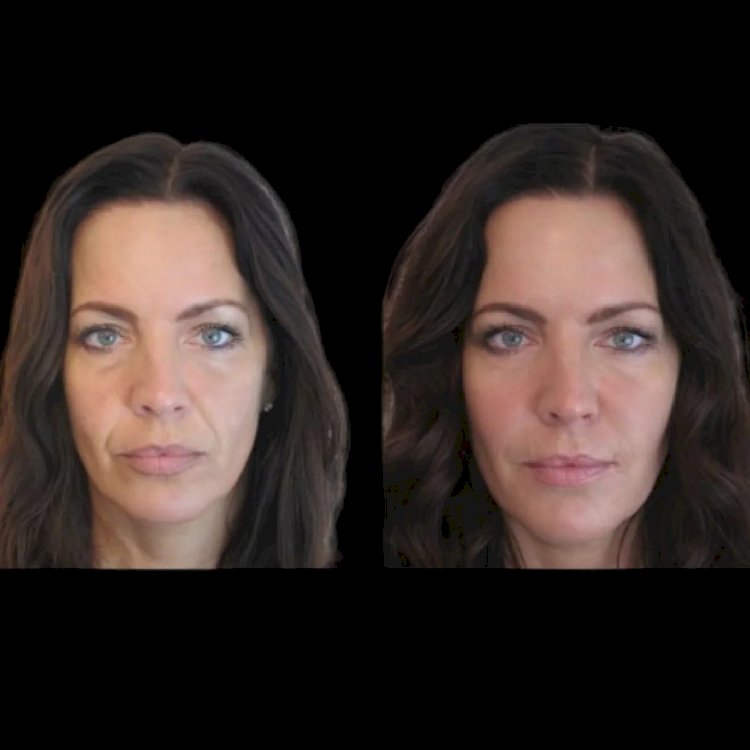 Achieve a Sculpted Jawline with the Best Plastic Surgeon in Dubai for Jawline Fillers